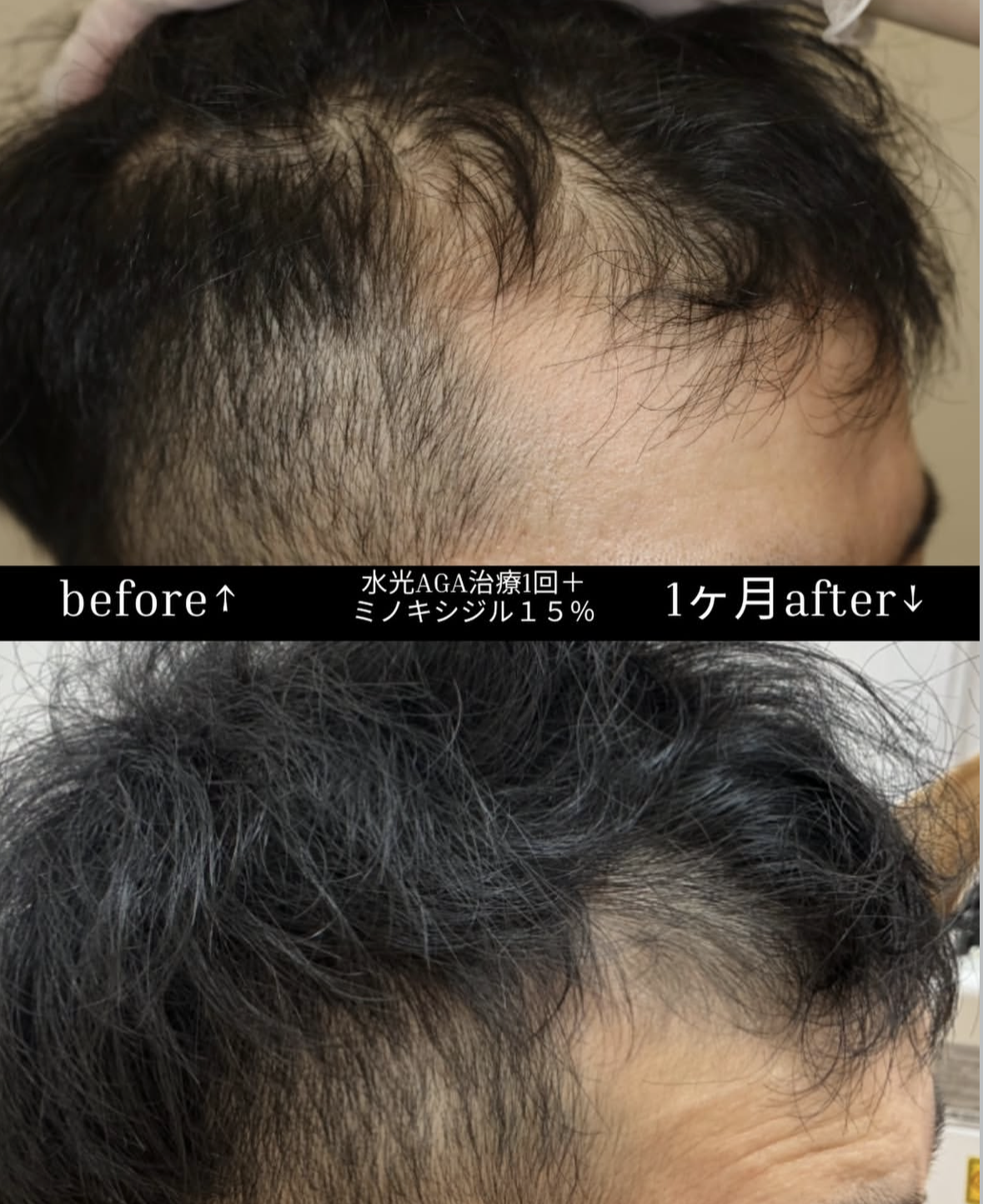 水光注射×ミノキシジル外用で始めるAGA治療 | 咲くらクリニック